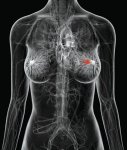 Рак груди, причины возникновения, лечение